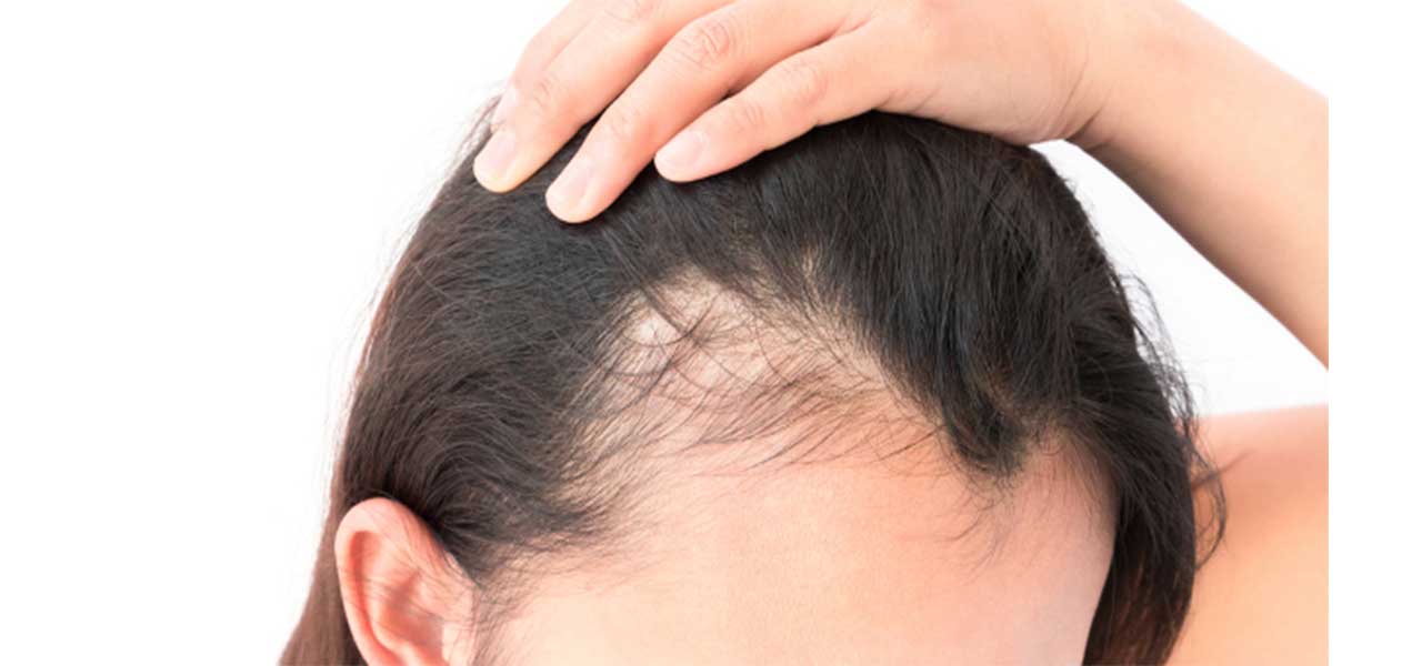 Read more about the article Alopecia acquired from the child or adult